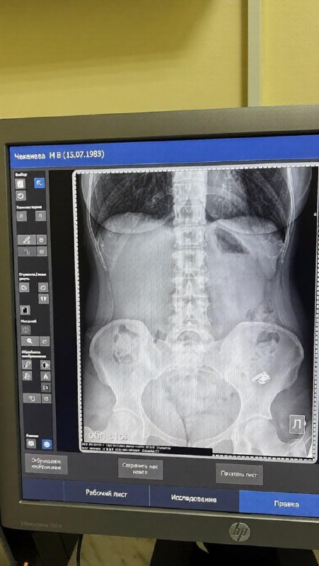 Уфимка случайно проглотила AirPods, перепутав его с таблетками.
Девушка рассказала, что держала в