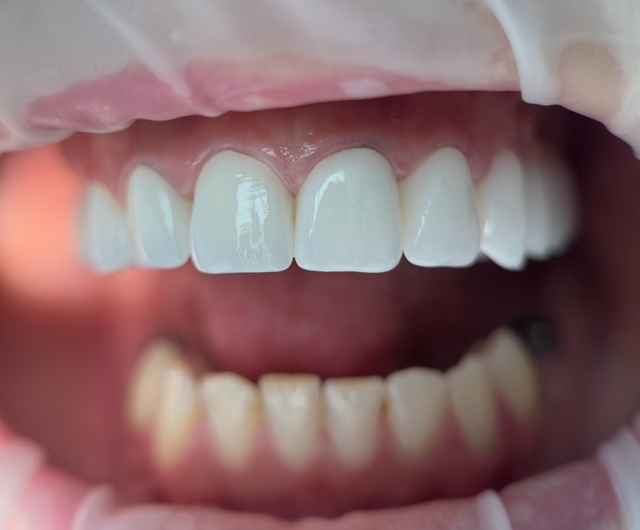 Консультация+Осмотр+Снимок всех зубов=БЕСПЛАТНО
😍 Ак...