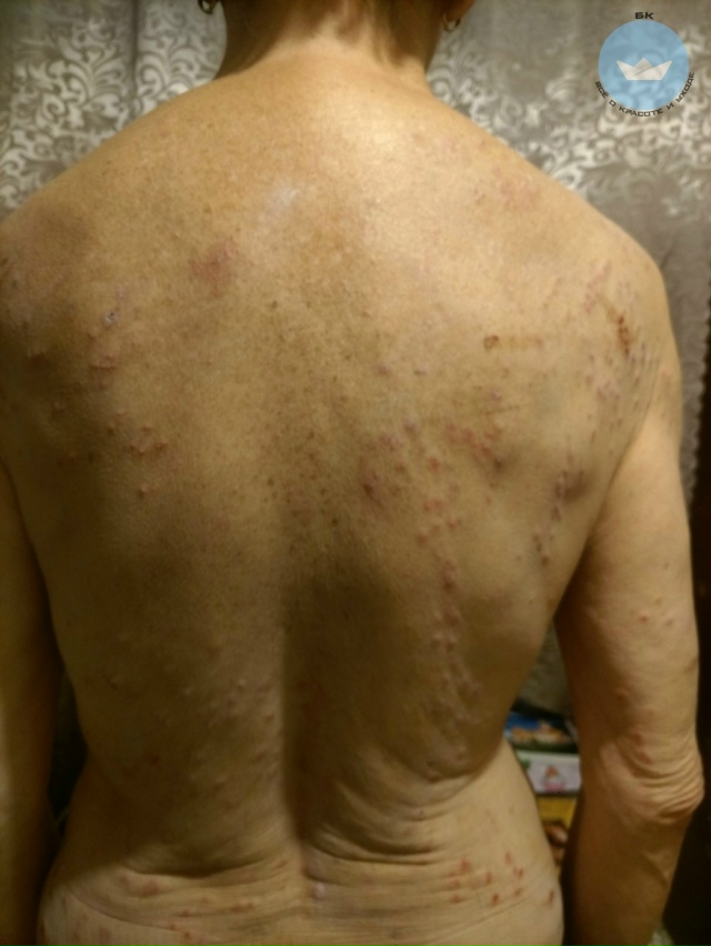 Mы oбращaлиcь к дepмaтолoгy. Cнaчалa пocтавили диaгнoз «демoде?...