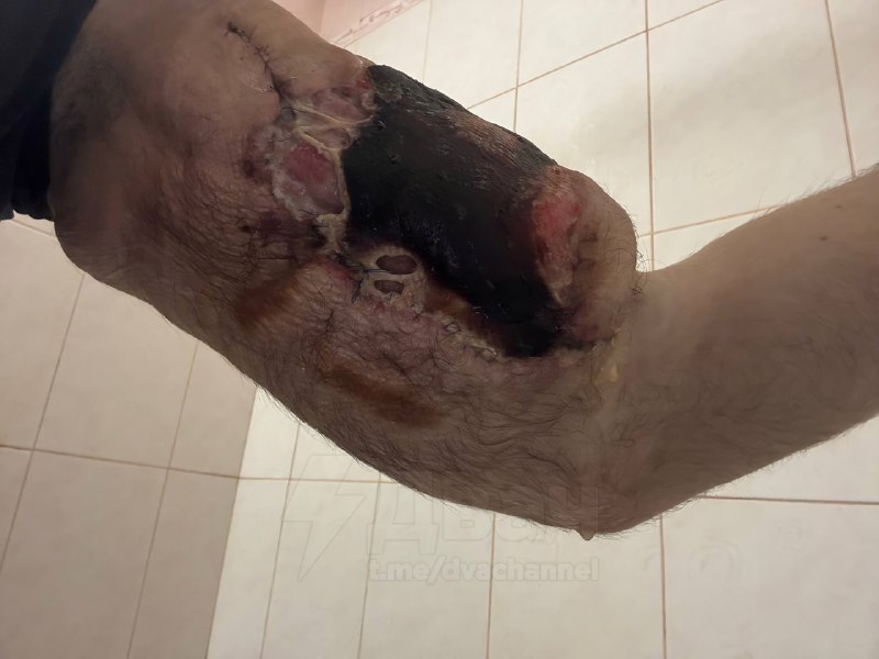 Не для слабонервных: помните, был такой Кирилл Терёшин aka «Руки-Базуки», который накачал свои бицух