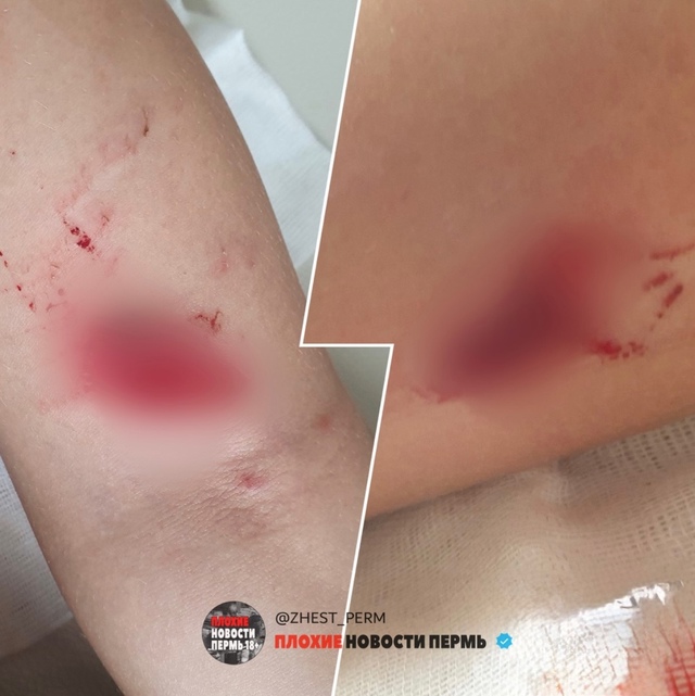 В Чернушке свора собак покусала 8-летнюю девочку. СКР р?...