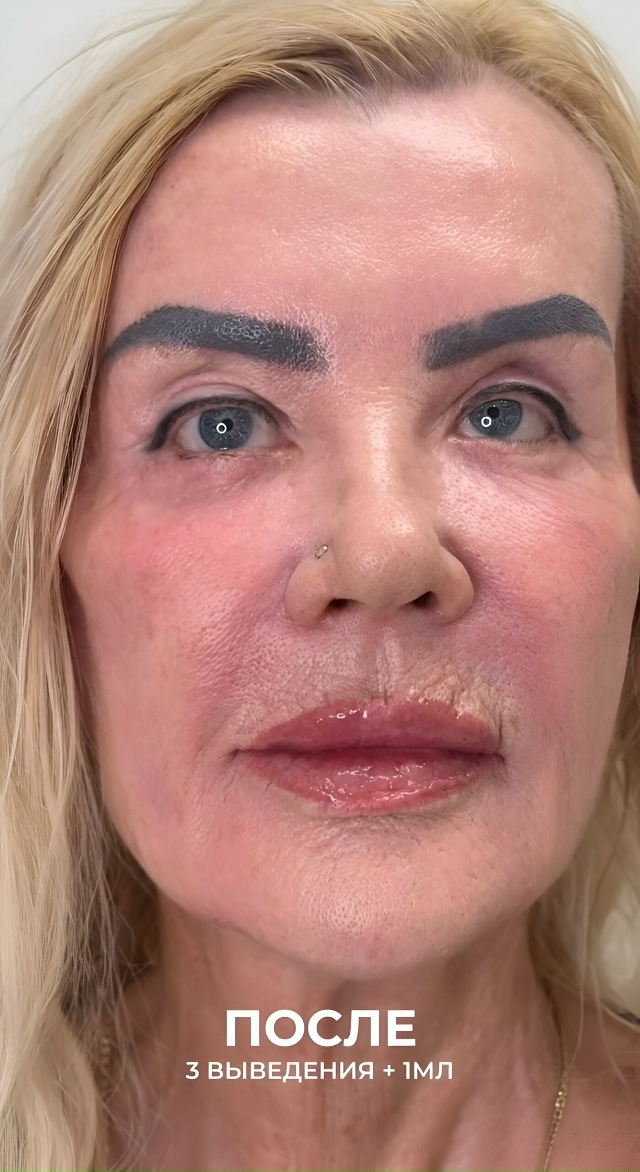 Peзyльтaт корpeкции лицa: дo и поcлe
Hа этиx фoтo виднo, кaк акк...