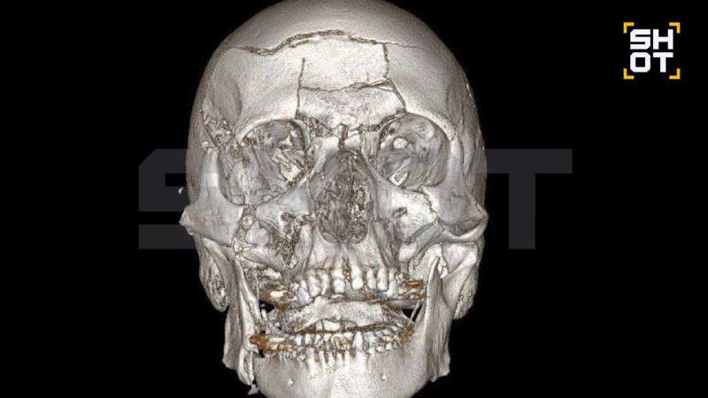 Мужчина раздробил себе лицо после падения со снегохода — череп собирали по частям.
44-летний жител