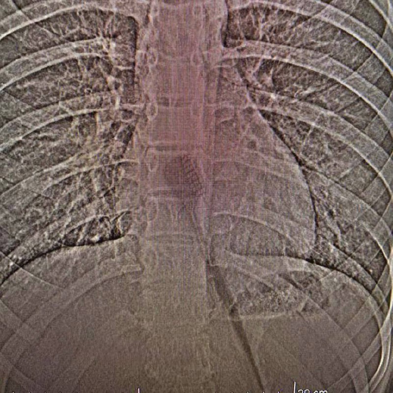 В Татарстане 13-летняя школьница случайно проглотила зубную щётку длиной почти 20 см — та полностью