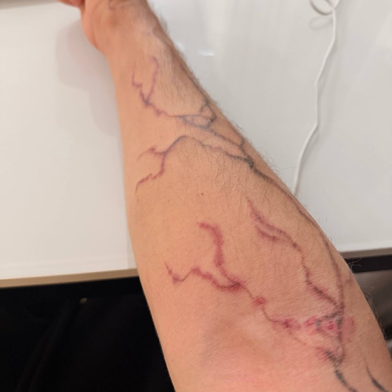 Откатываемся к заводским настройкам 😅
Удаление тату - тот ещё «спа-процедурный» опыт 😰