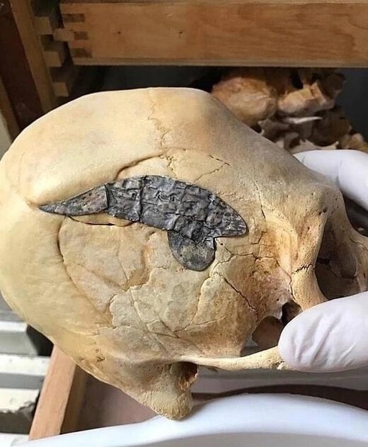 Металлическая пластина, вставленная в череп перуанско...