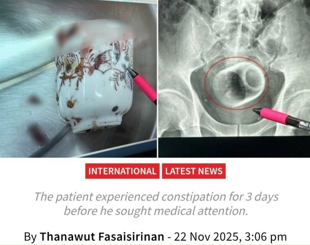 В его прямой кишке застряла кружка длиной около восьми...