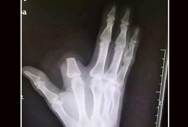 Мужчина после укуса змеи сам отрезал себе палец, чтобы остановить яд, но врачи ему сказали, что змея