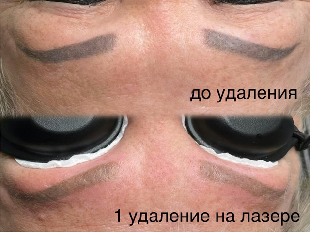 Лазерное осветление (удаление) перманентного макияжа: ...