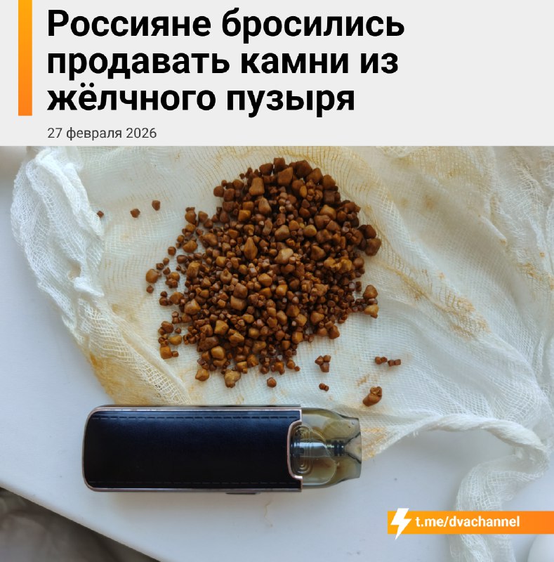 Россияне начали массово продавать свои камни из жёлчного пузыря
Пациенты забирают их после операций