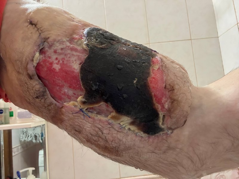 Не для слабонервных: помните, был такой Кирилл Терёшин aka «Руки-Базуки», который накачал свои бицух