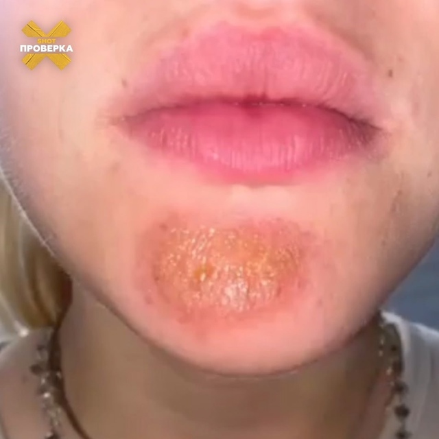 ‼️Поцелуй с бородатым мужчиной может вызвать кожную ?...
