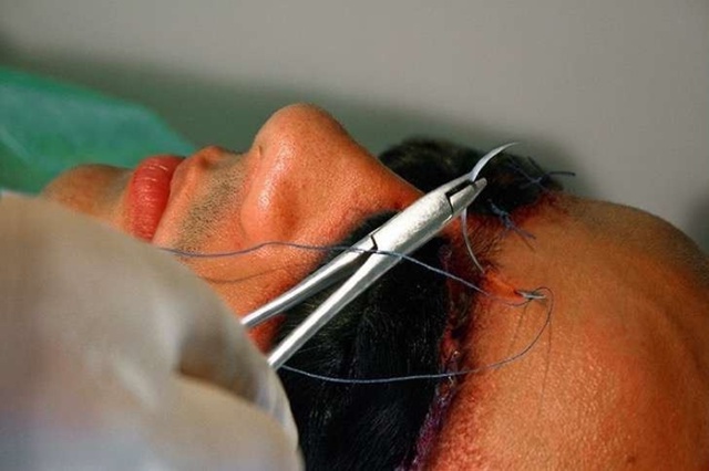 Родриго Брага из Бразилии подверг себя операции для то...