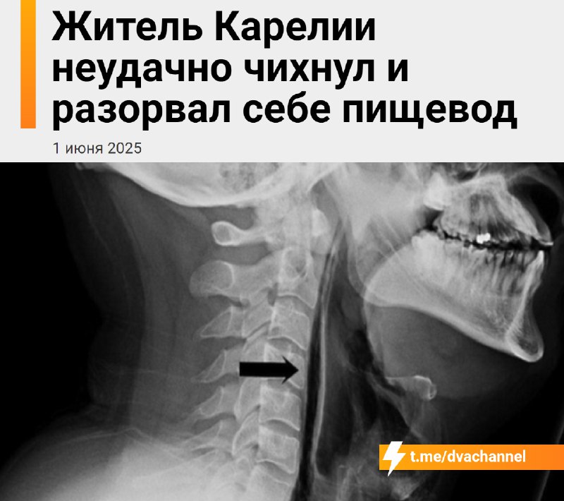 Неудачно чихнул и разорвал себе пищевод мужик в Карелии
34-летний бедолага попытался сдержать чихан