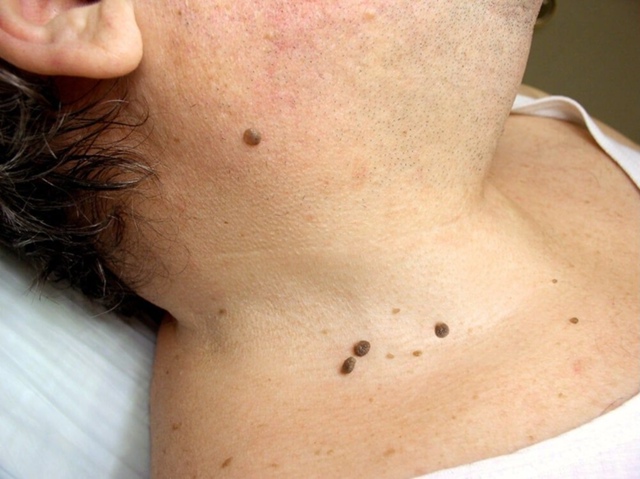 👋 Заметили папилломы на шее, кератомы или рост родино?...