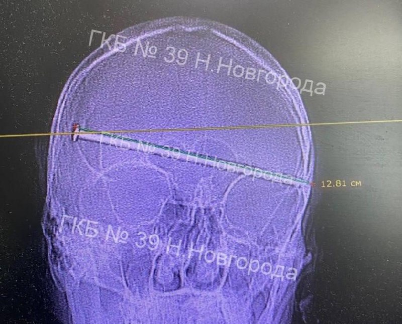 В Нижнем Новгороде мужик чудом выжил после того, как 12-сантиметровый гвоздь полностью вошёл ему в г