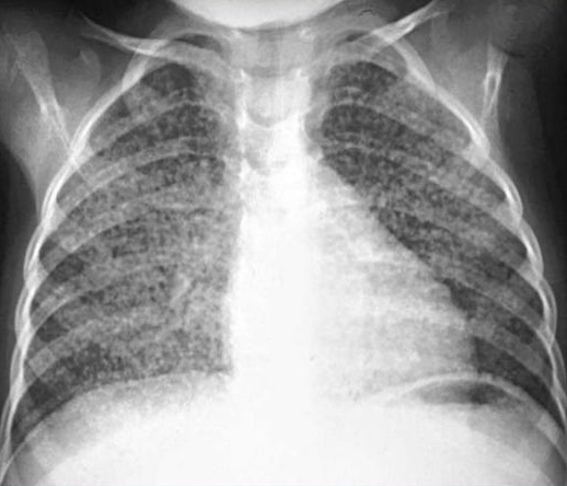 Я недавно заболел туберкулёзом. В данный момент лежу в ...