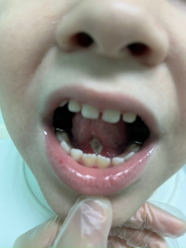 Анонимно. На фото итог операции на подъязычную уздечку...