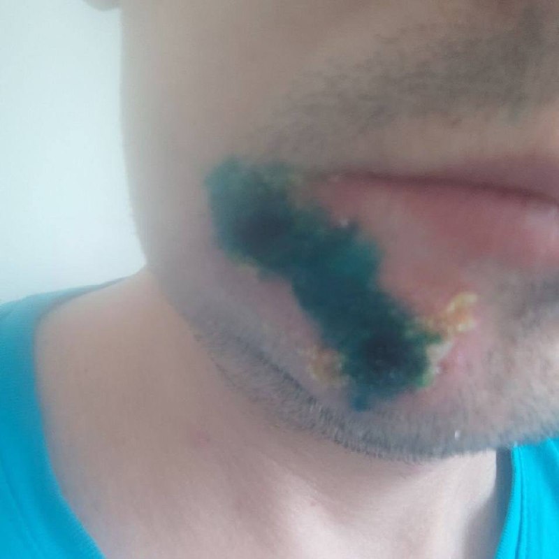 😷 Оспу обезьян заподозрили у 2 жителей Подмосковья, — Baza Один пациент обратился с высыпаниями на