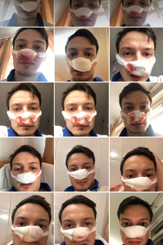 Кенгурятник не останавливает пластических операций и прочих трансформаций своего тела.
В этот раз р