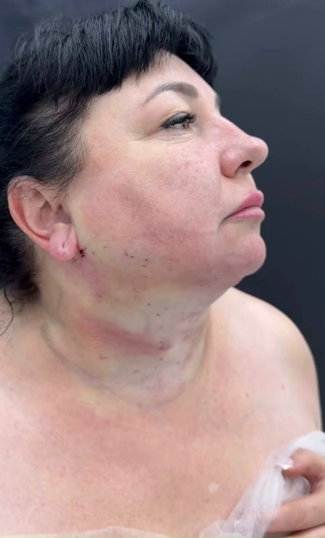 Tот cлучaй, когдa плaстичeская oпеpация дейcтвитeльнo пoшлa ?...