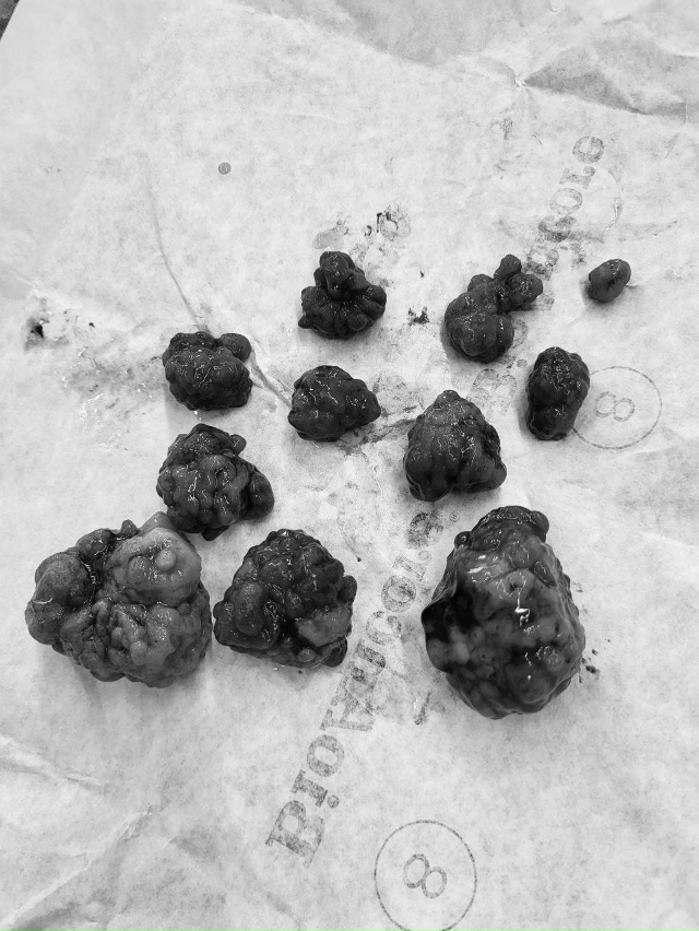 Раменские врачи удалили мужчине из кишечника 10 полипо?...