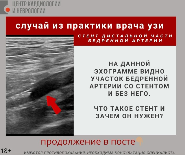 Стент — это специальная металлическая конструкция в ф...