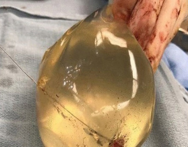 😉Силиконовый имплант стал настоящим спасителем для д...