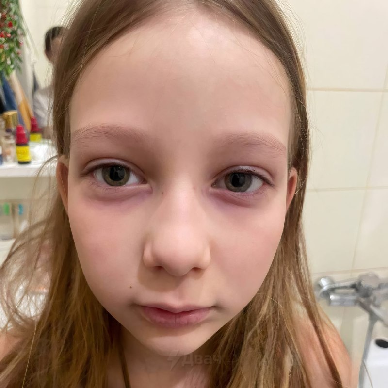 В Томске мать целую неделю лечила 10-летнюю дочку от загадочной болезни — у девочки внезапно появили