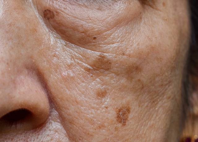 👋 Заметили папилломы на шее, кератомы или рост родино?...