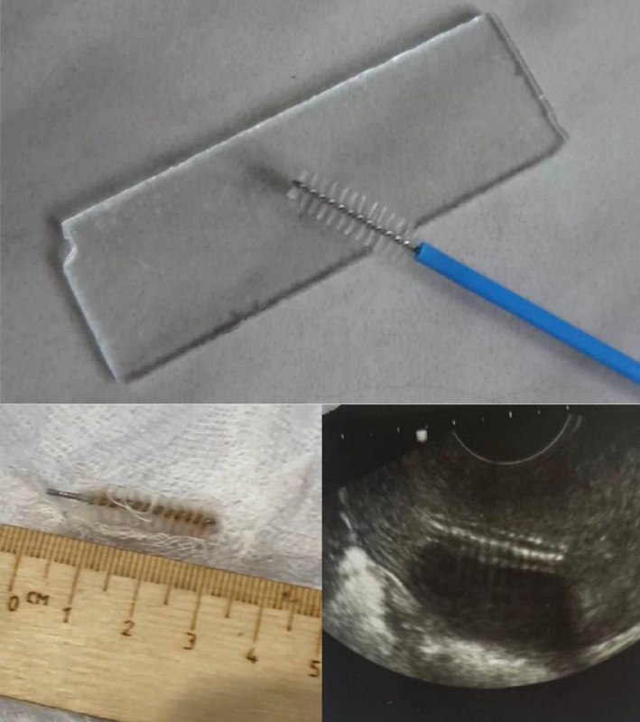 Обычный чекап обернулся для 32-летней Надежды операционным столом: гинеколог забыла у неё в матке ёр