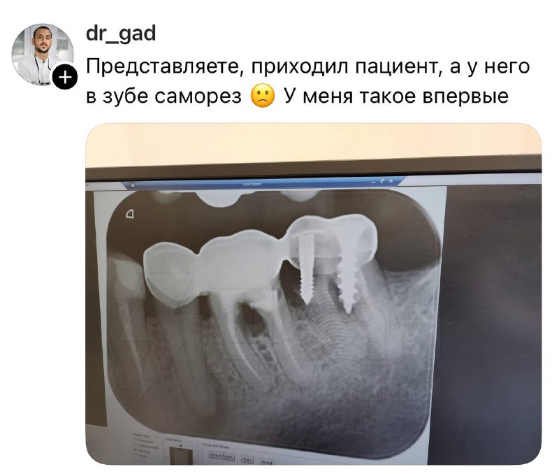 Чел пришёл к стоматологу с вкрученным в зуб… саморезом
Врачу пришлось срочно удалять винт, потому ч