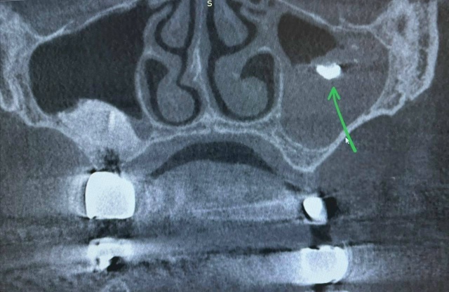 😱 В Видном врачи извлекли зубную пломбу из носовой па?...