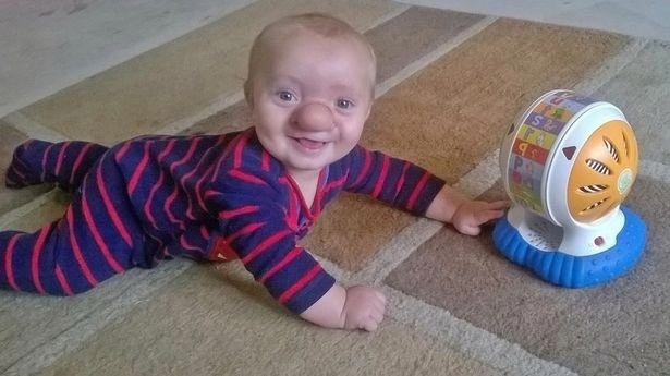 Маленький Олли Трезис родился с редким отклонением, из...