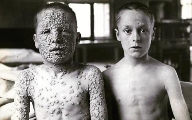 В 1910 году два 13-летних мальчика одновременно заболели ?...