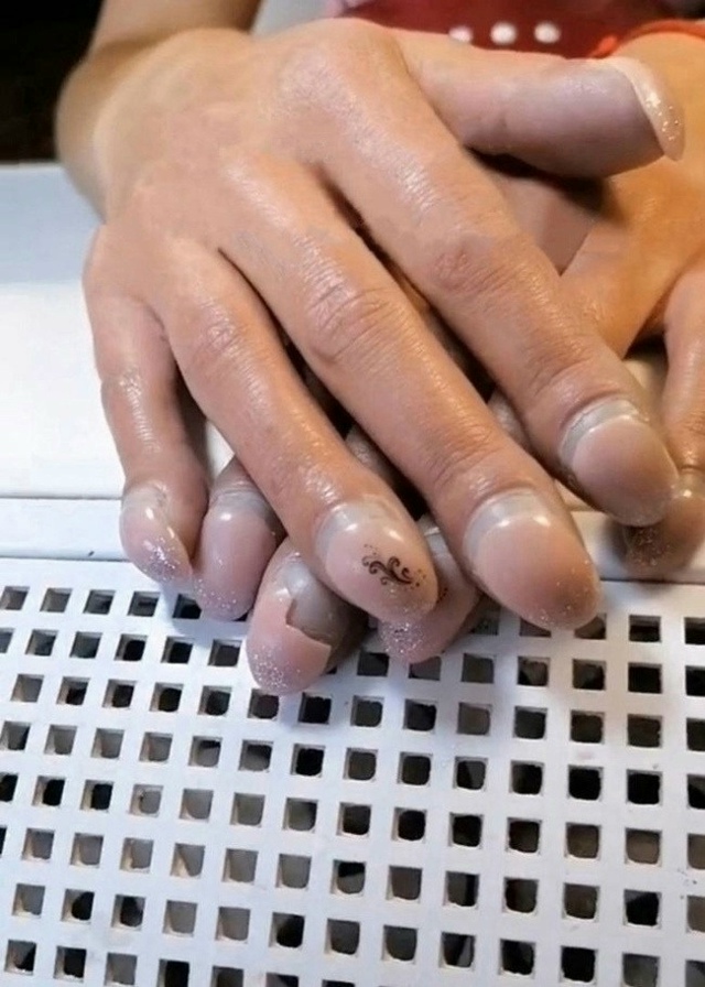 Симптом, известный как «барабанные палочки» или «паль?...