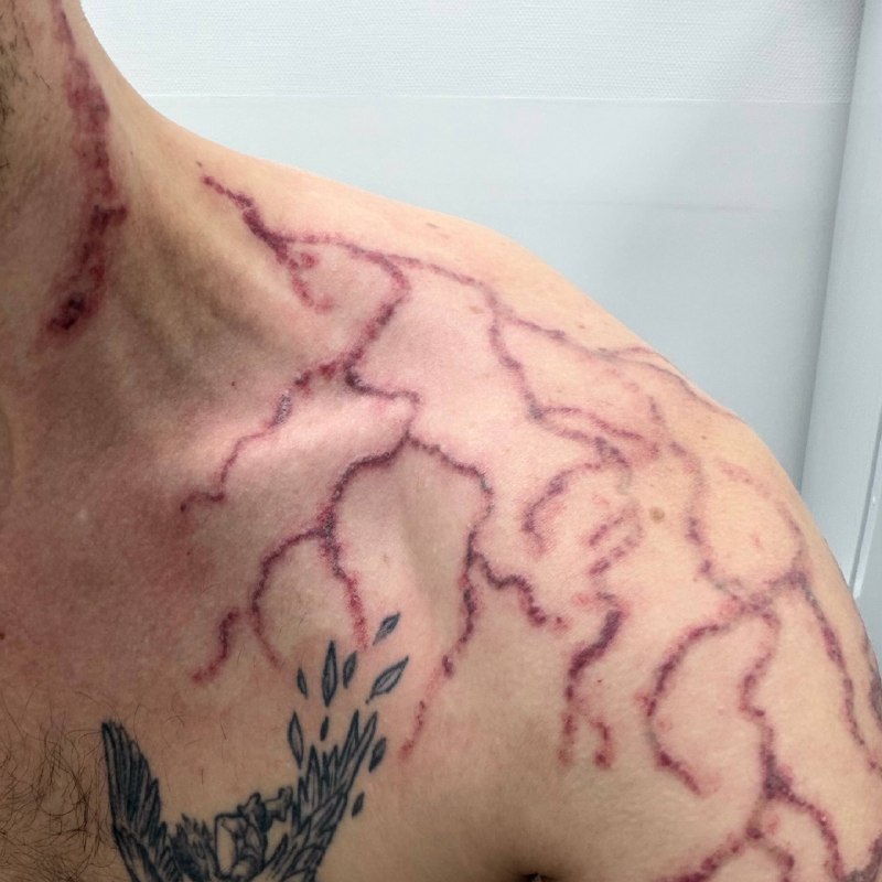 Это кошмар, друзья 😭
Удаление продолжается.
В этот раз прямо жестко, но результат хороший, на шее п