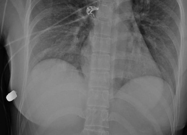 😉Силиконовый имплант стал настоящим спасителем для д...