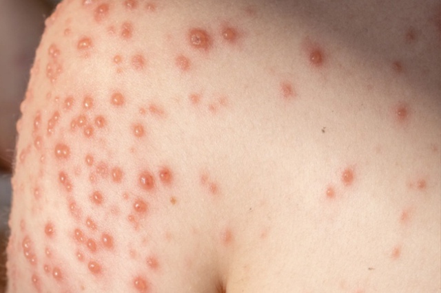 ❗️ Ветрянка стремительно распространяется по России ...