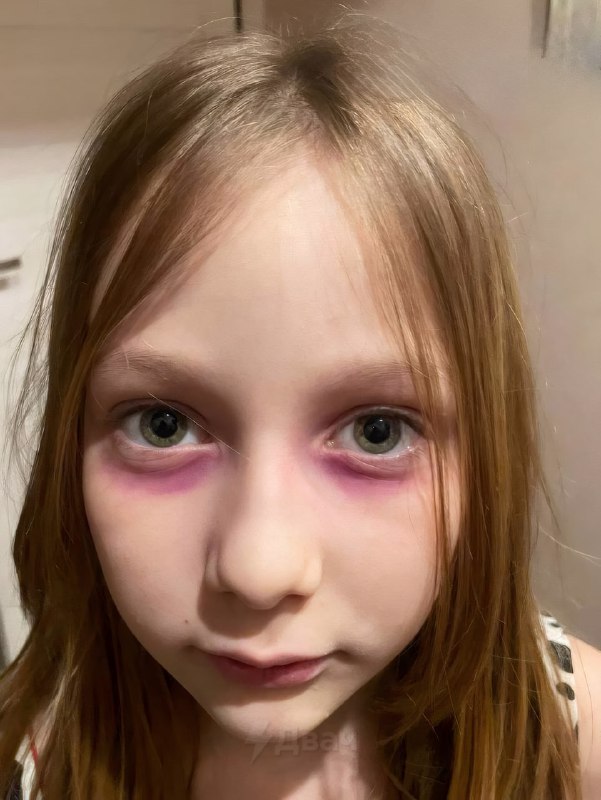 В Томске мать целую неделю лечила 10-летнюю дочку от загадочной болезни — у девочки внезапно появили