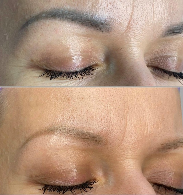 Лазерное осветление (удаление) перманентного макияжа: ...