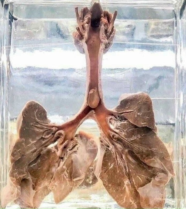 Плюс еще одна фобия...
На фотографии легкие человека, к?...