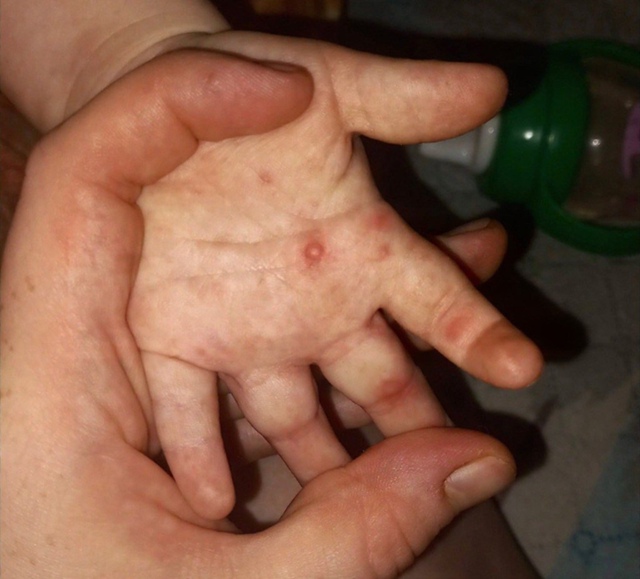 ? Вирус Коксаки массово заражает детей по всей России...