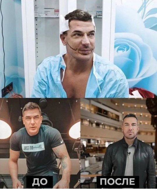 Пересадка мужественности.😱😱 Бывший муж Ксении Боро?...