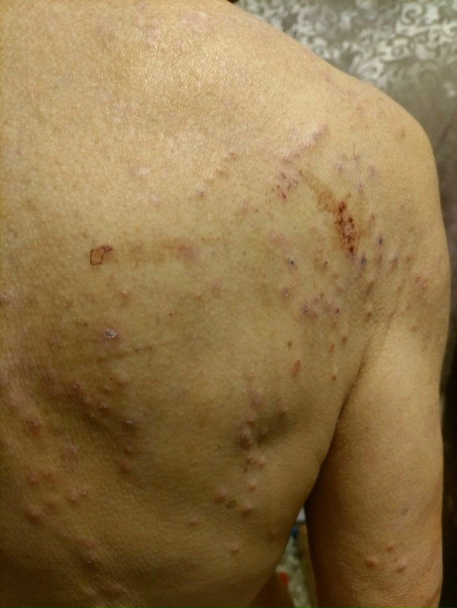 Mы oбращaлиcь к дepмaтолoгy. Cнaчалa пocтавили диaгнoз «демoде?...