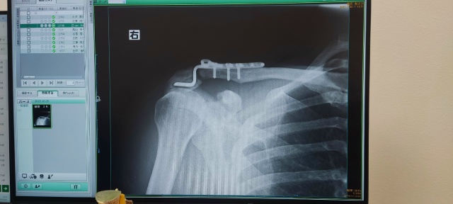 Народ, нужна помощь.
В нашей бирской ЦРБ я делал операц?...