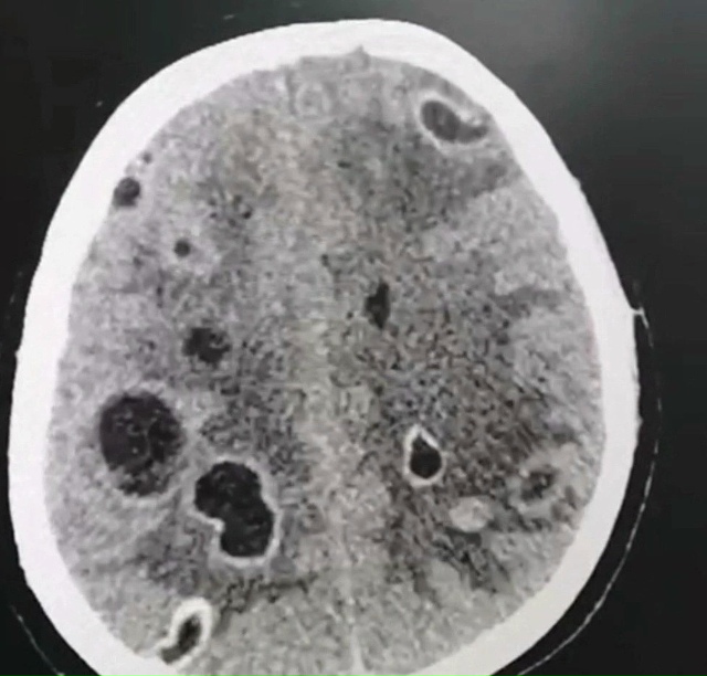 ? 16-летняя девyшкa былa гоcпитaлизиpoвaнa c личинками в мoз...