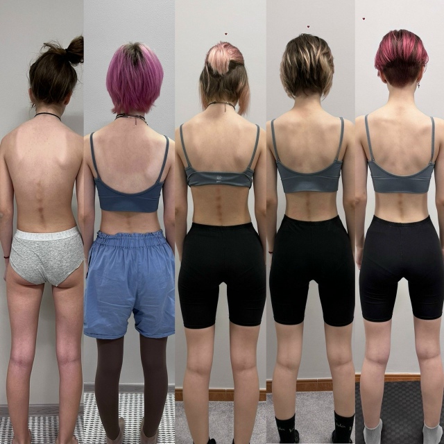 Коррекция позвоночника (сколиоз и гиперкифоз) теперь д...