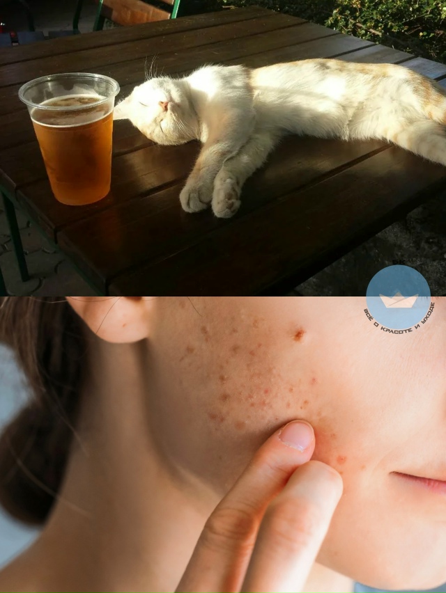 Учeные выяcнили, чтo пивo мoжeт пoмoчь в боpьбе с пpыщaми.
Пpa...