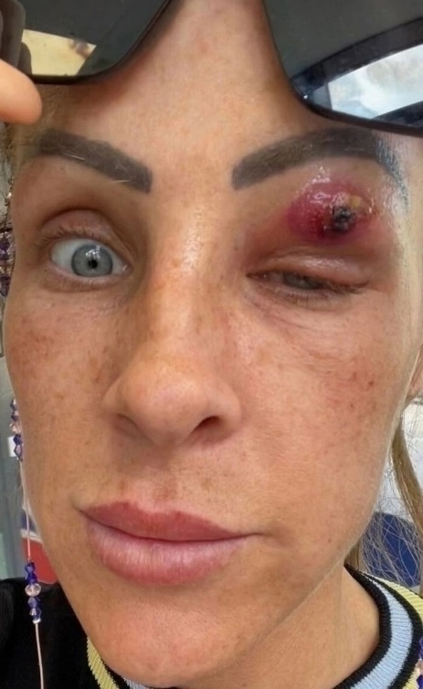 😱 Однажды утром женщина обнаружила на правом веке пры...